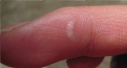 burn blister